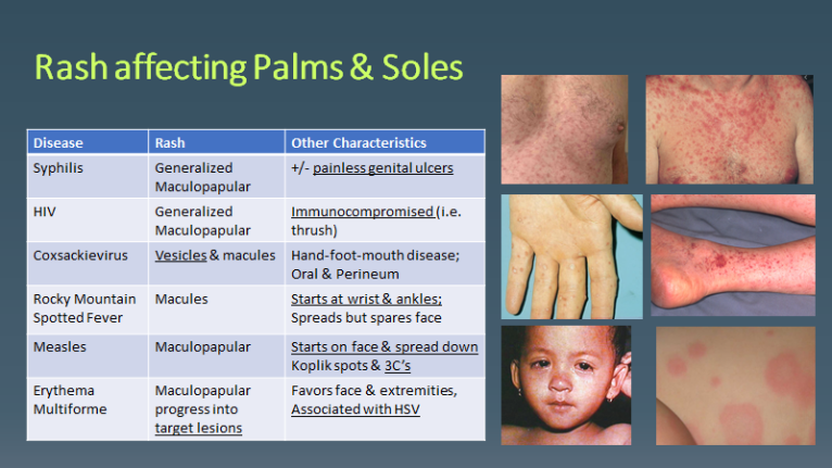 Rash Affecting Palms And Soles Secondary Syphilis Scvmc Im Chief